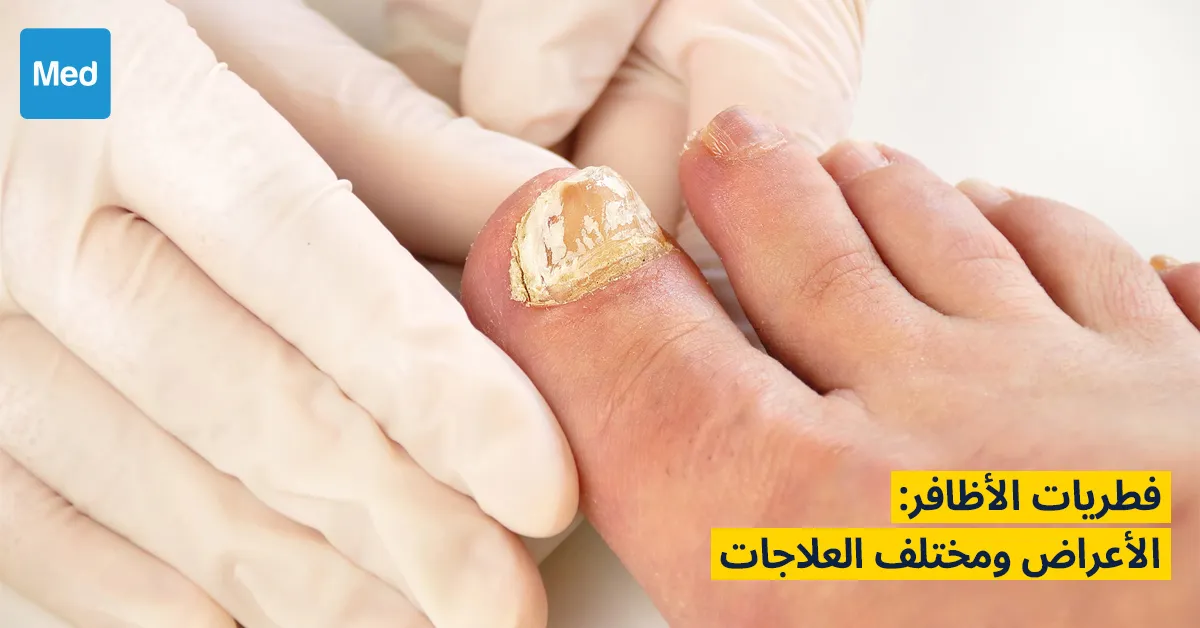 فطريات الأظافر: الأعراض ومختلف العلاجات